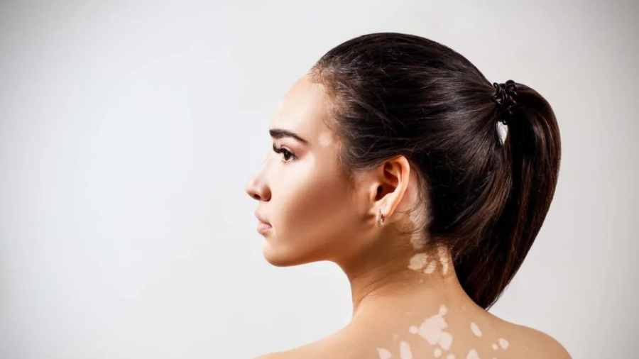 백반증 완벽 가이드