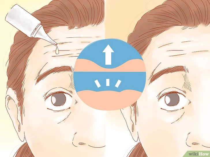 이마주름 없애기