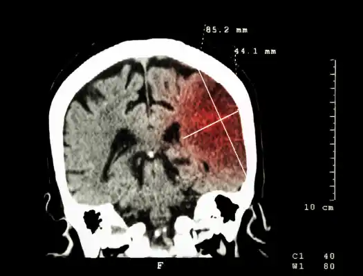 뇌경색 전조증상 및 치료 방법&amp;#44; 좋은 음식 알아보기