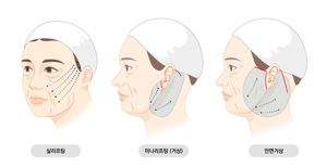 미니 리프팅 가격