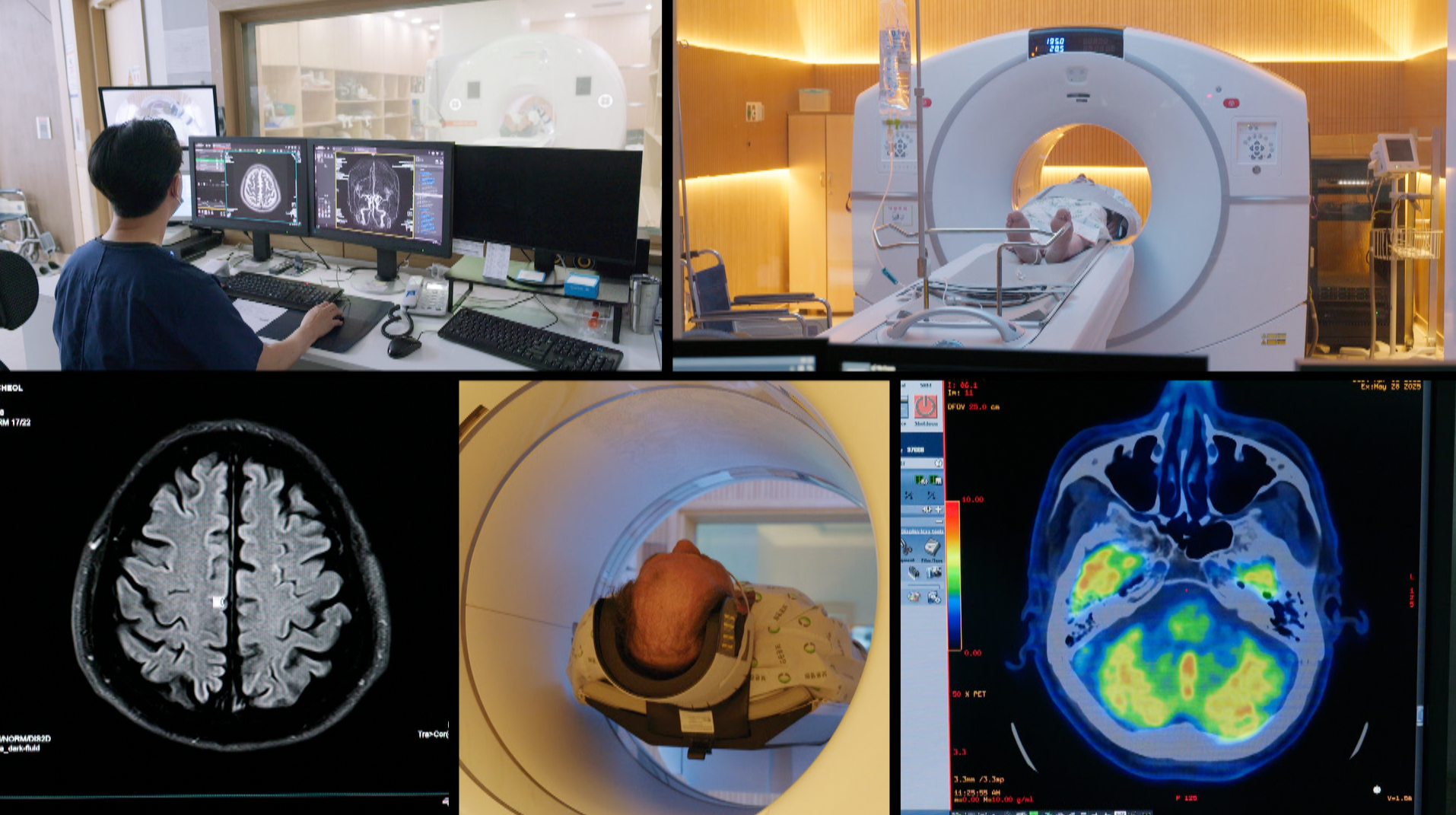 명의/알코올성 치매-당신이 술을 끊어야 하는 이유