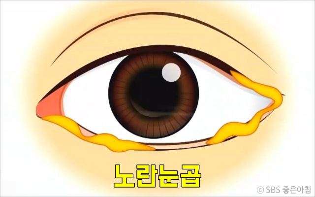 고름 같은 노란 눈곱이 끼는 이유 눈질환 아폴로 눈병 결막염 증상 충혈, 건강 팁줌 매일꿀정보