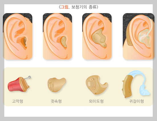 보청기 종류