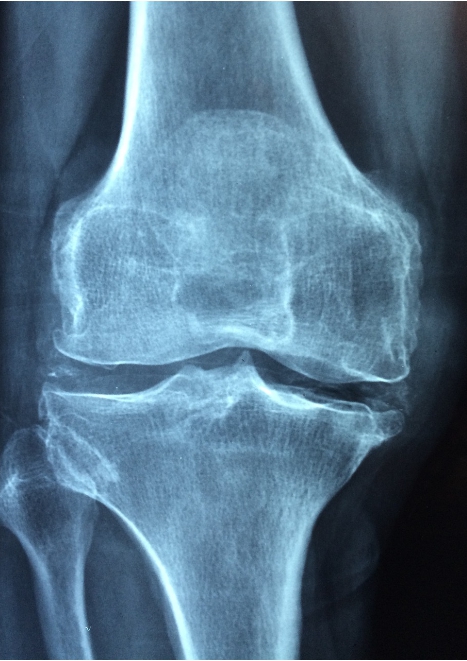 Recommended Joint Supplements