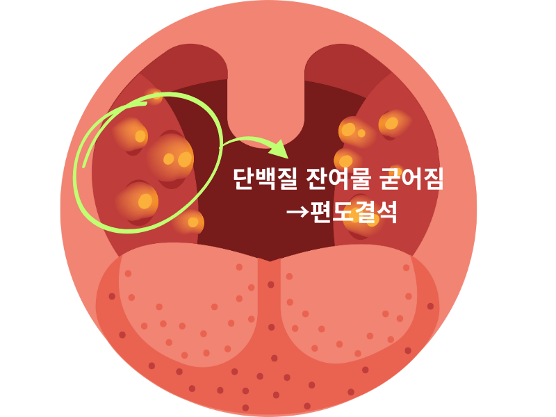 편도 표면 굴곡과 단백질 찌꺼기가 굳어 편도결석이 형성되는 과정 설명 이미지