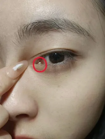 눈물샘 뚫는 수술 간단한가요에 대한 수술정보_8