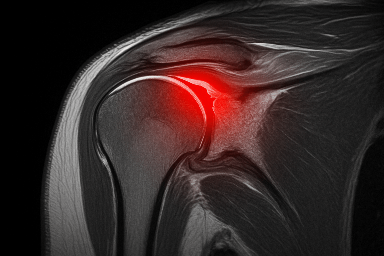 회전근개 파열 정확한 진단이 중요한 이유