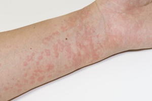 알루미늄 알레르기