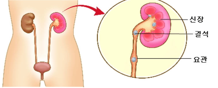 요로결석-증상과-원인