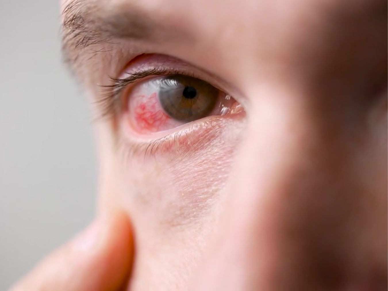 모기기피제 부작용 충혈