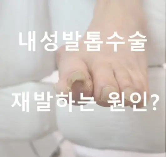 내성발톱