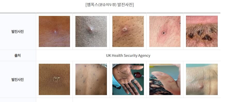 엠폭스 발진 사진