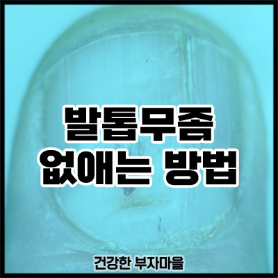 발톱무좀 없애는 방법