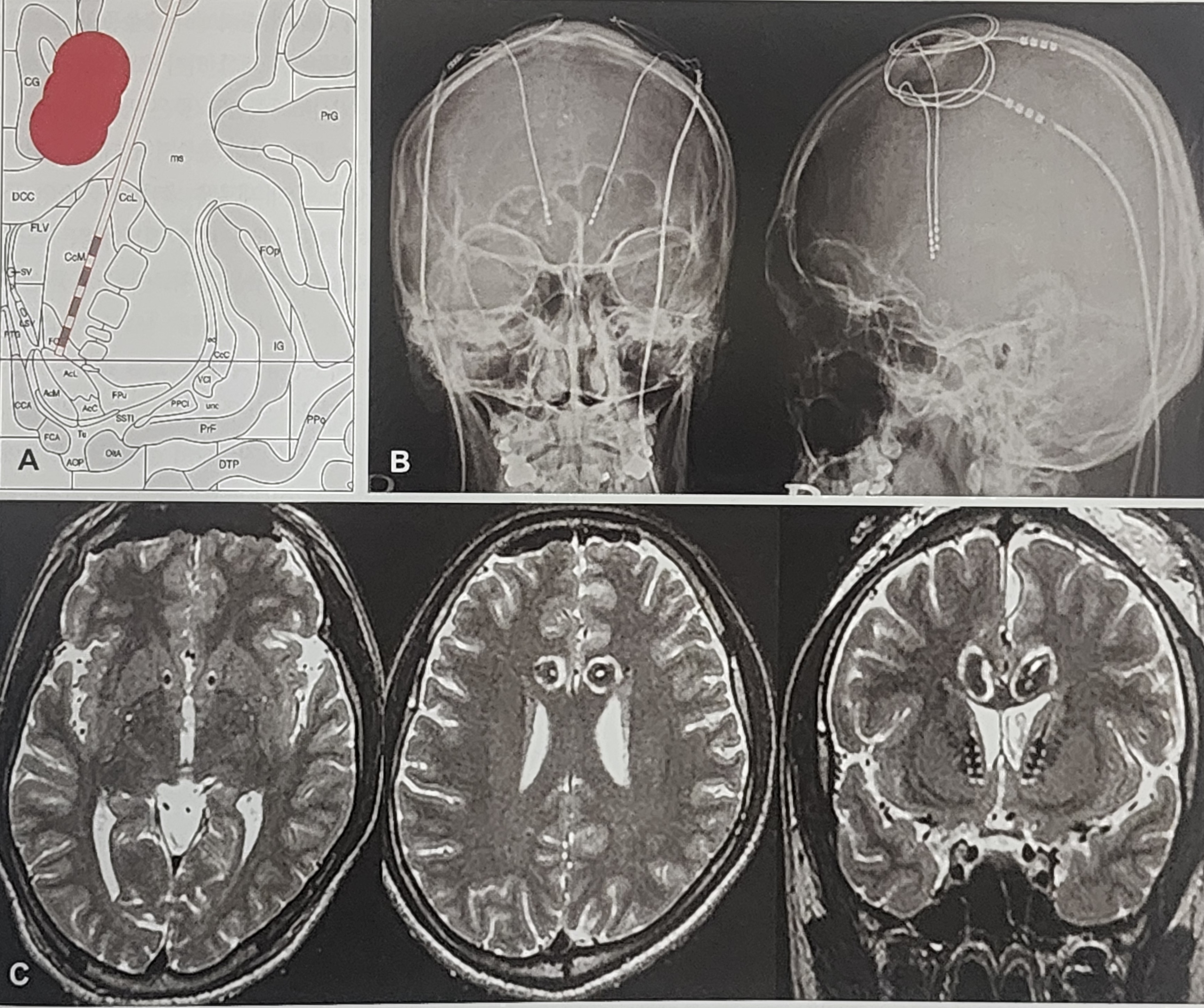 정신질환의 수술적 치료