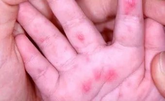 수족구병 증상과 예방 조치 방법 모음_3