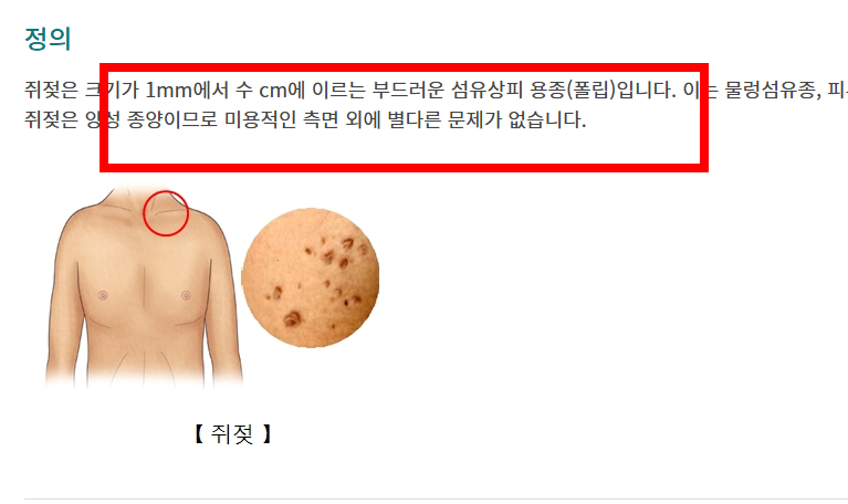 쥐젖 제거방법 알아보기