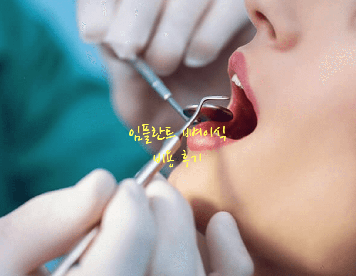 임플란트 후기