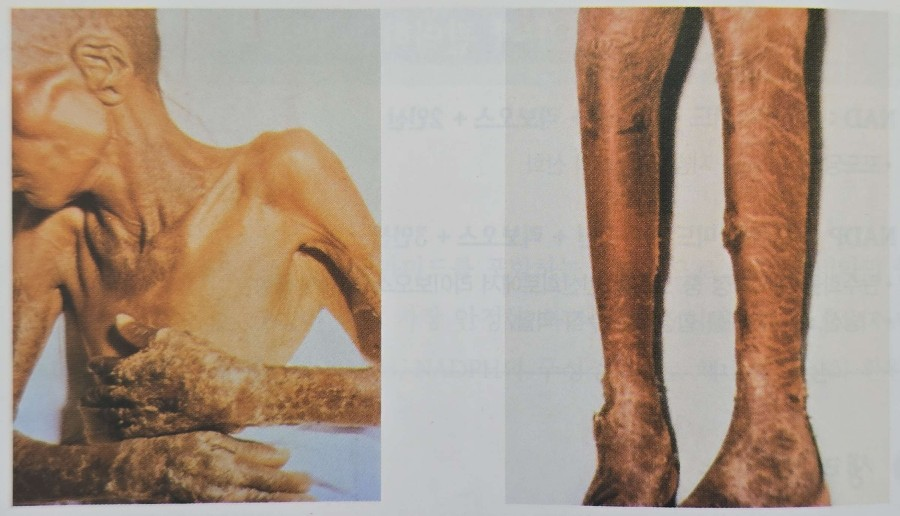 펠라그라로 인한 피부염