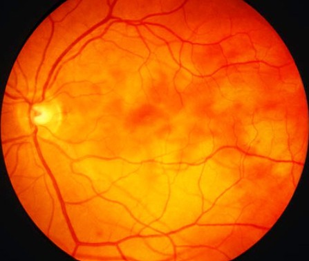 유리체 출혈된 모습