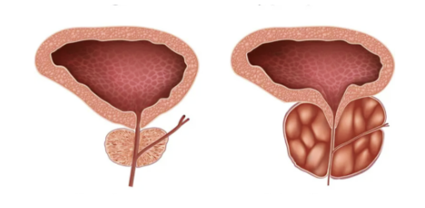 전립선 비대증의 예방법