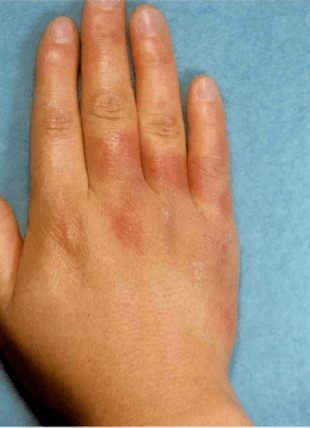 손으로-온-봉와직염