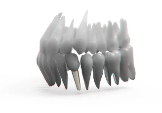 임플란트 식립 수술