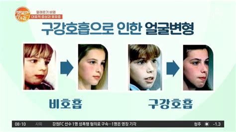 비염
