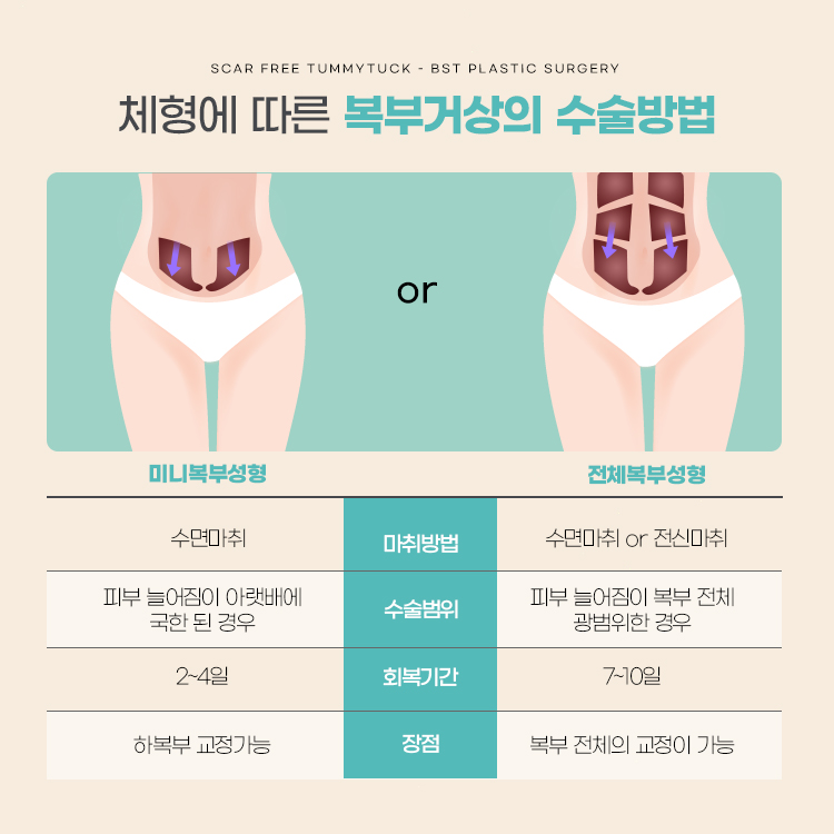 미니복부성형
수변 마취, 피부 늘어짐이 아랫배에 국한된 경우, 2~4일, 하복주 교정가능

전체복부성형
수면마취 또는 전신마취, 피부 늘어짐이 복부 전체에 광범위한 경우, 7~10일, 복부 전체의 교정이 가능