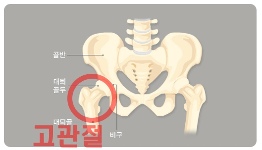 카본화 단점 고관절 통증