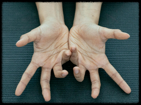 손경직-열성경련