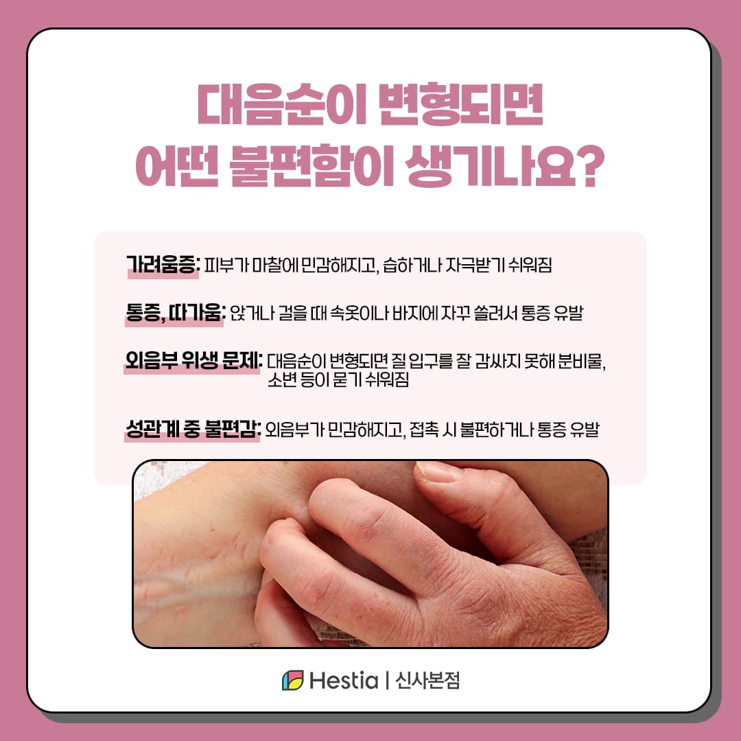 대음순이 변형되면 어떤 증상이 생기나요?
