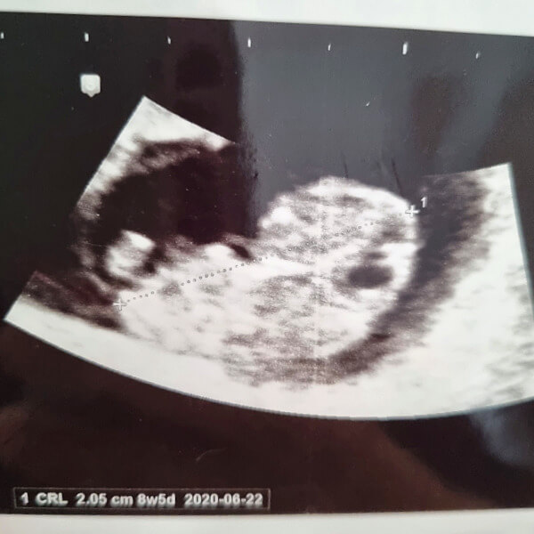 병원에서할수있는초음파계산법