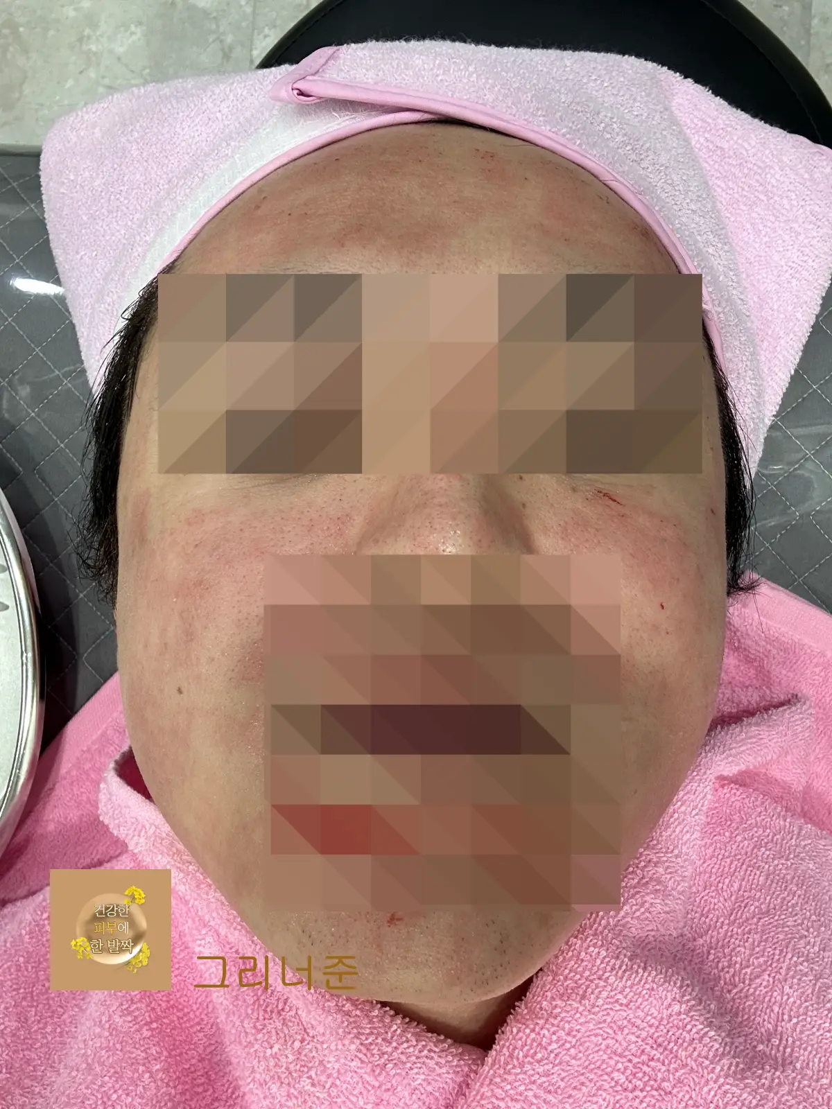 포텐자-시술-직후-출혈-피부-붉어짐