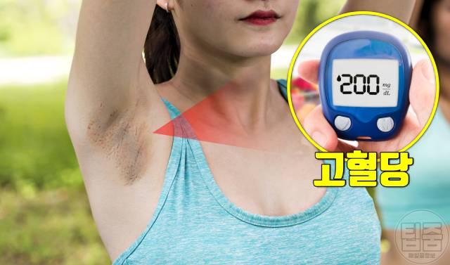 피부병 목에 검은 얼룩 겨드랑이 착색 당뇨병