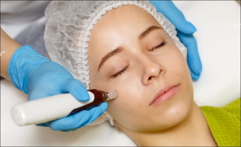 비립종 레이저 치료