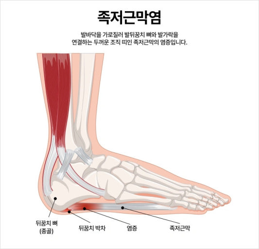 족저근막염의 증상 및 원인, 치료방법