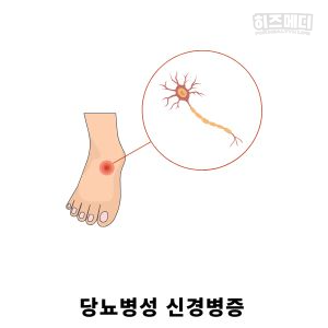 당뇨병 초기증상