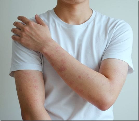 자반증 원인 및 주요 증상과 좋은 음식