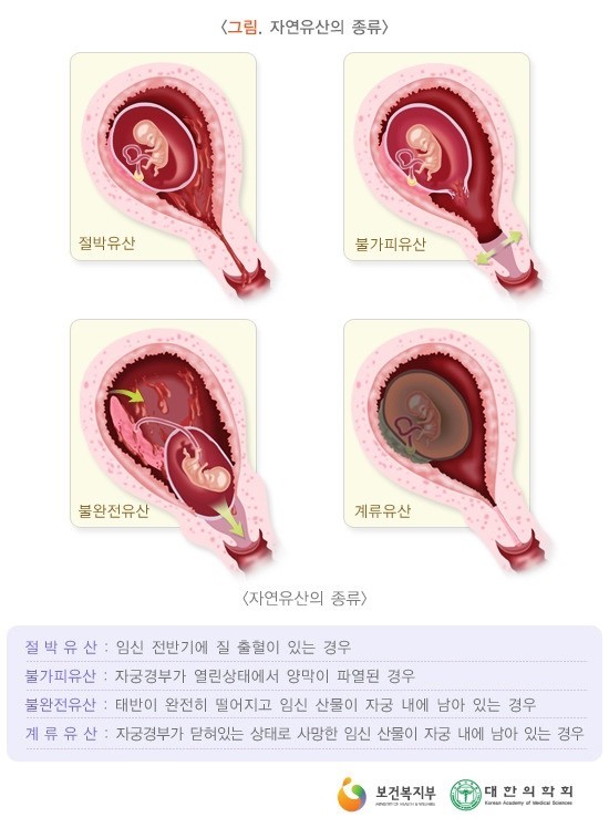 여성 부인과-유산의 종류, 원인, 증상, 치료방법.