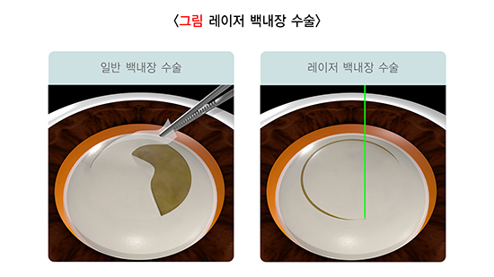 레이저 백내장 수술