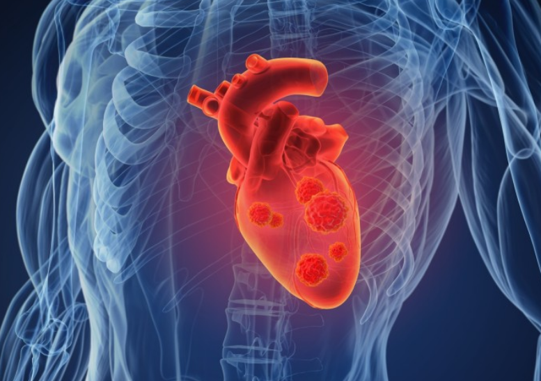 심장마비 예방법