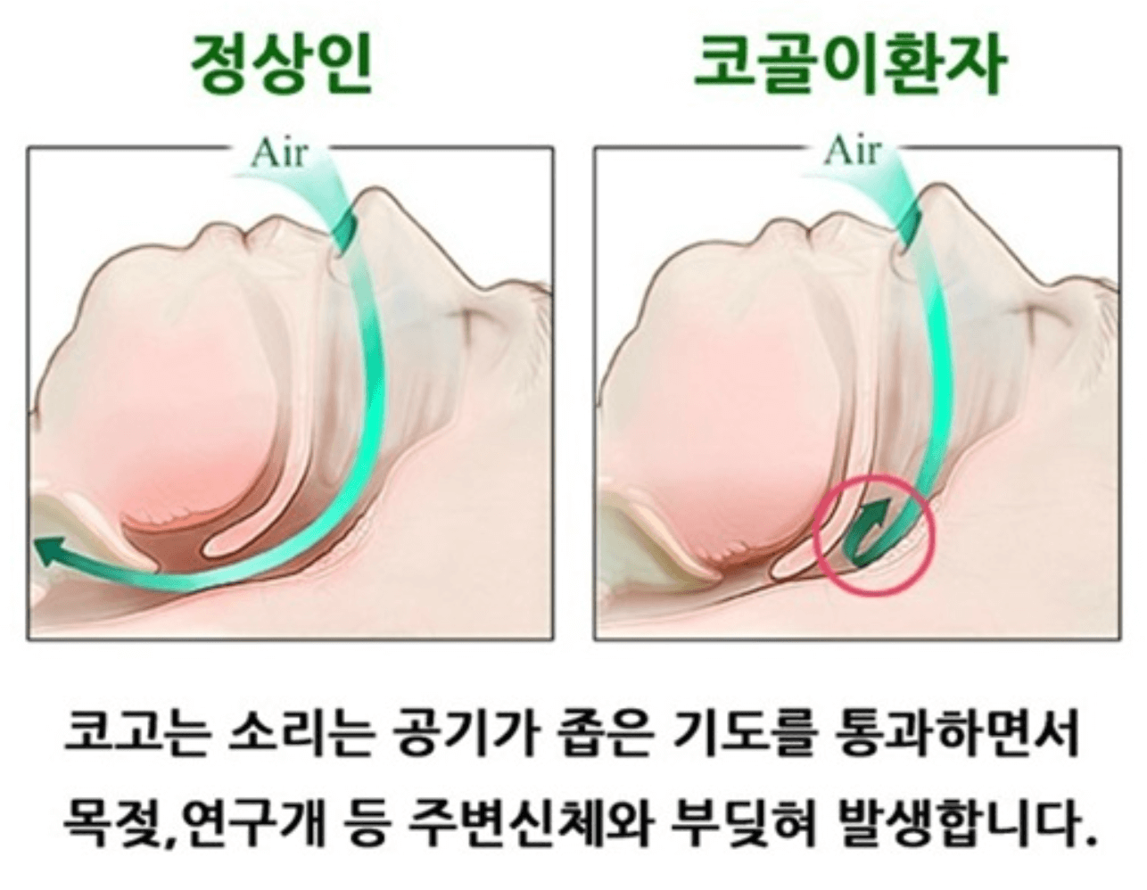코골이 원인
