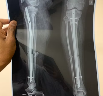 콘드로이친 효능 복용법 시간 부작용