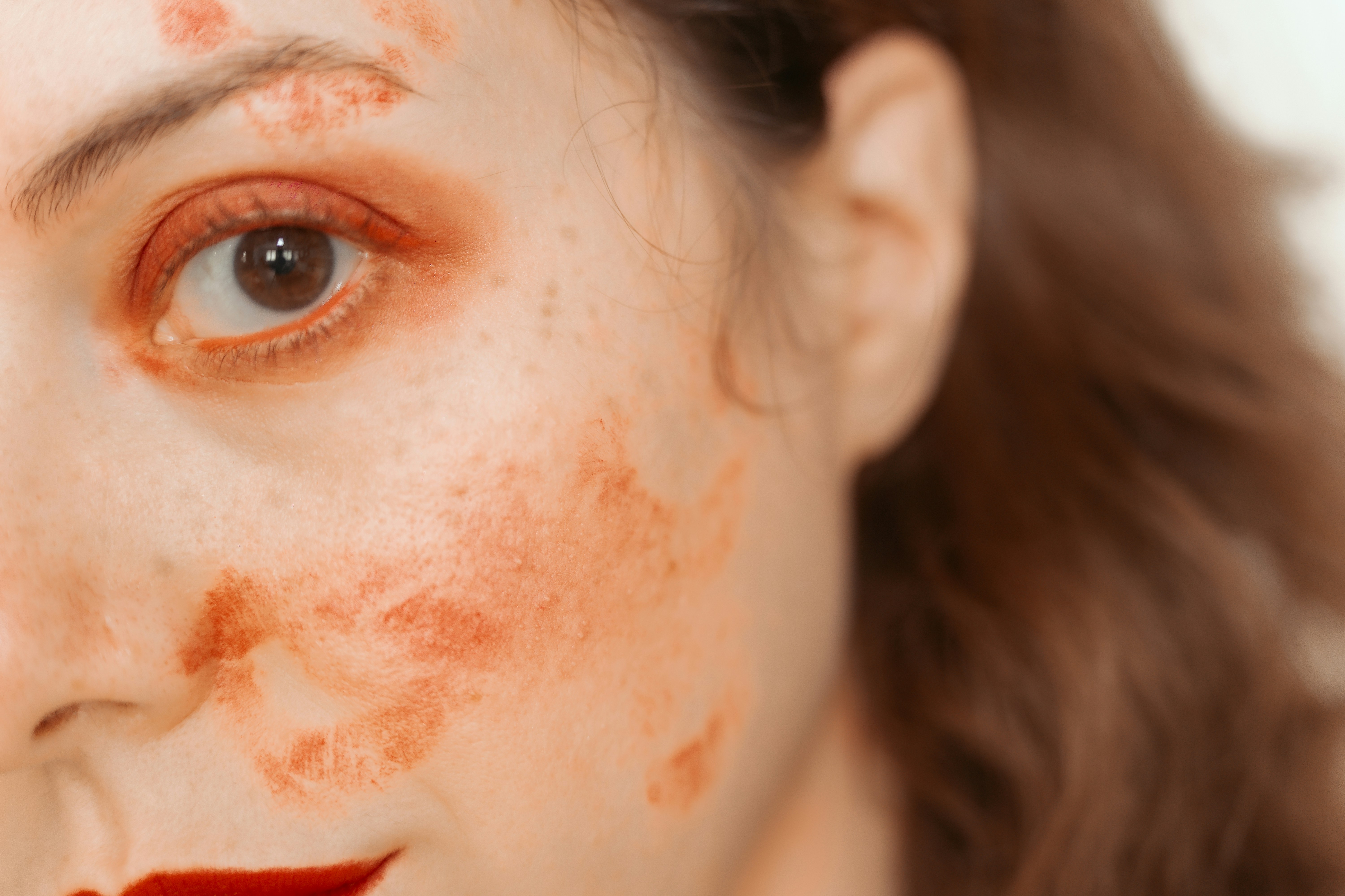 모낭염과 여드름 구별하기