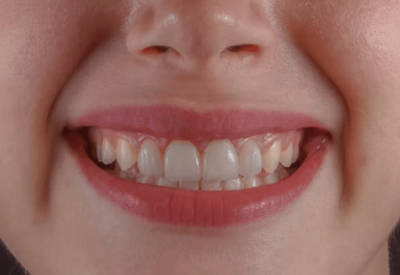 잇몸 영양제: 건강한 잇몸 만드는 필수 영양제 가이드