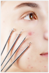 여드름 빨리 없애는 법