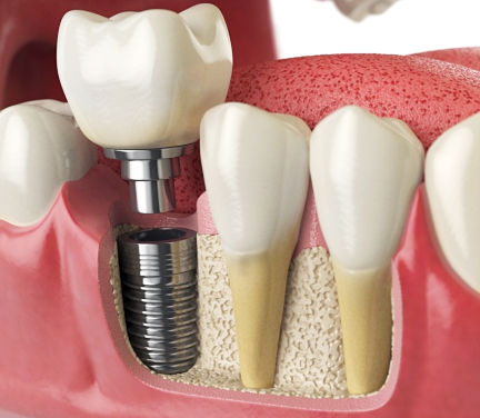임플란트 건강보험