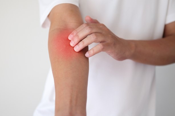 땀띠 대상포진 구별법