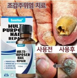 발톱무좀 가이드