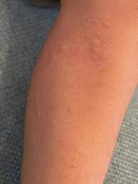 피부발진의 종류